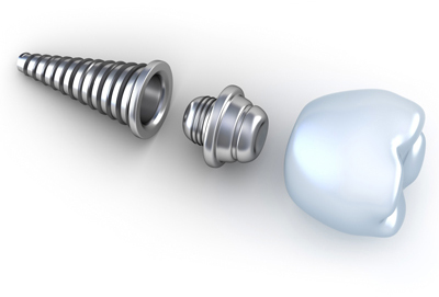 Dental_Implant_005